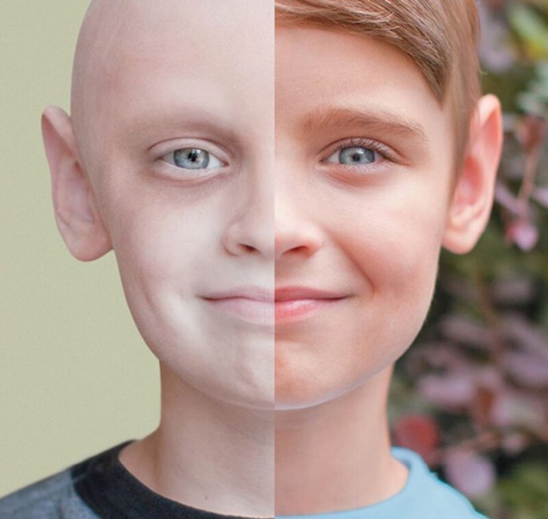Ребёнок с раком и после того, как вылечился