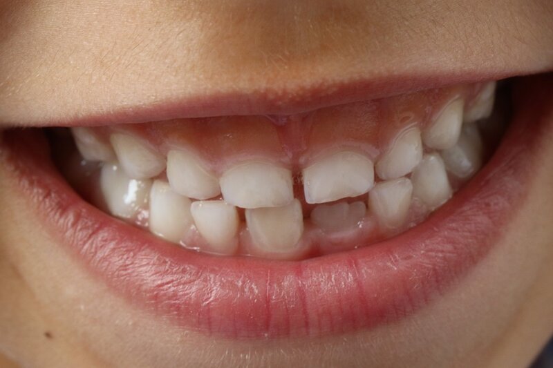 Кривые зубы – мужские гены, отвечающие за зубы и форму челюсти, сильнее, чем женские. От отца ребенок может получить не только кривые зубы, но и слабую эмаль