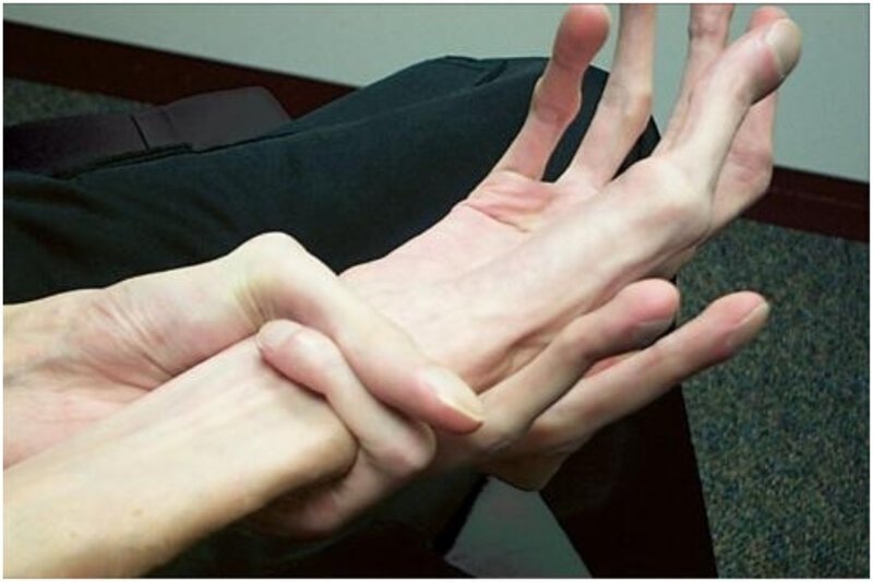 2 пальца на запястье. Синдром Марфана (арахнодактилия). Арахнодактилия паучьи пальцы. Паучьи пальцы синдром Марфана. Длинные пальцы синдром Марфана.