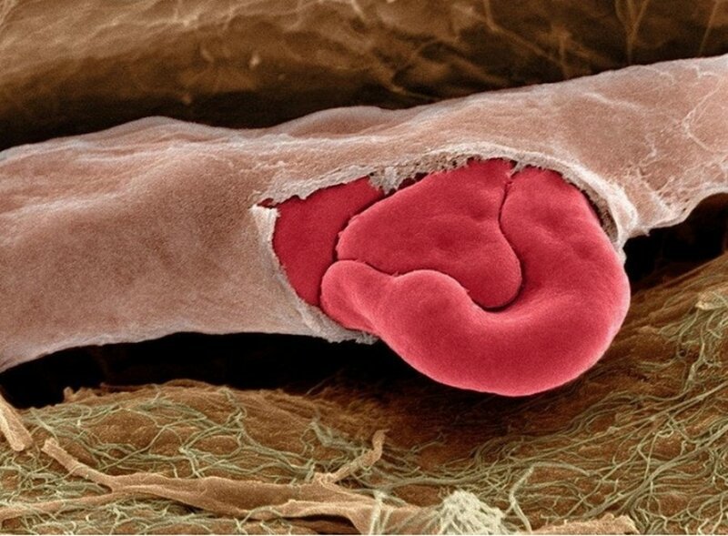 10. А это - поврежденный капилляр с красными кровяными тельцами внутри