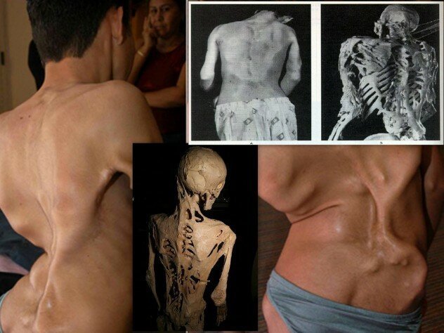 Каменные люди: фибродисплазия - история болезни