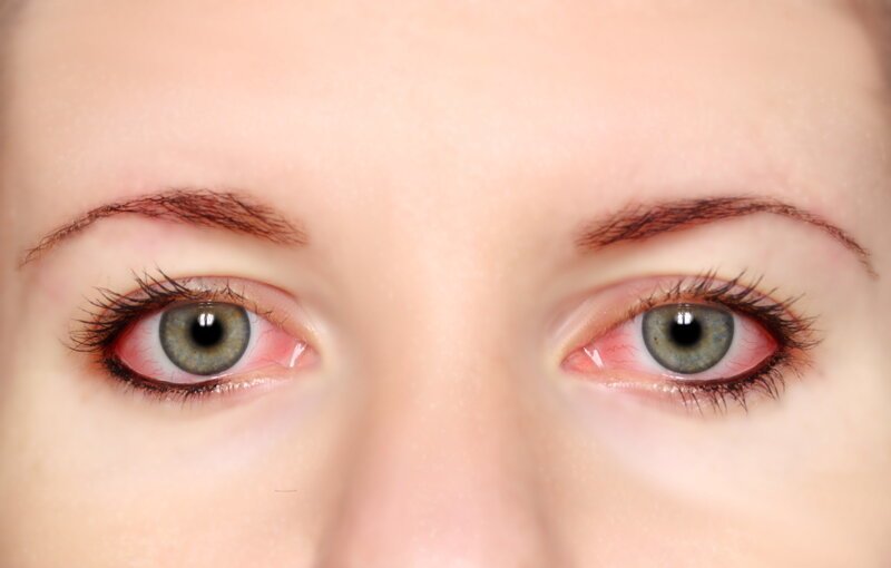 Почему краснеют глаза: причины появления симптома