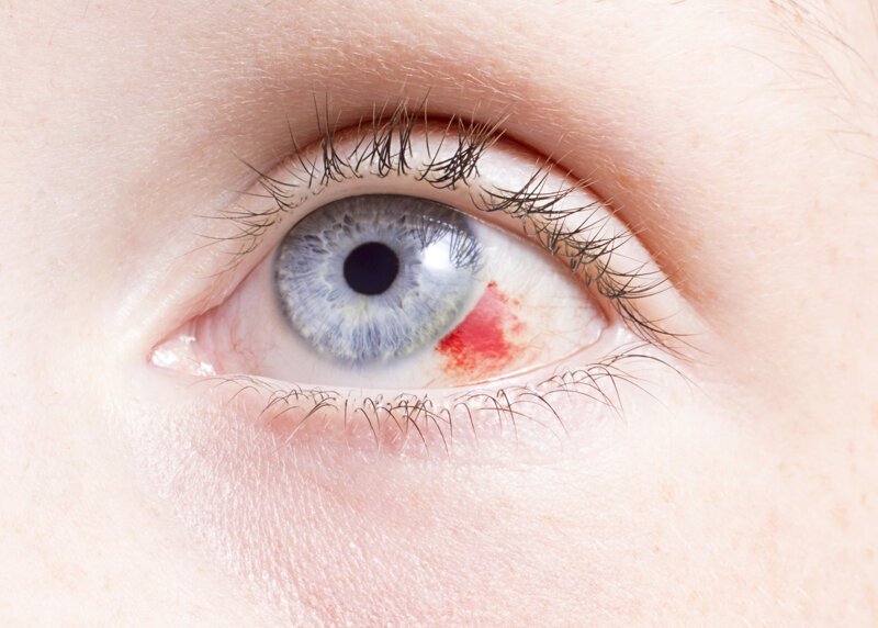 Характеристики основных причин покраснения глаз