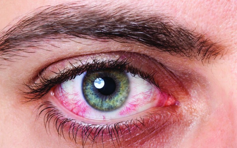 Дергающийся глаз как симптом других заболеваний