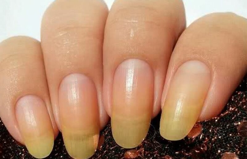 Из-за чего желтеют ногти на руках у женщин, и как можно быстро вернуть красоту