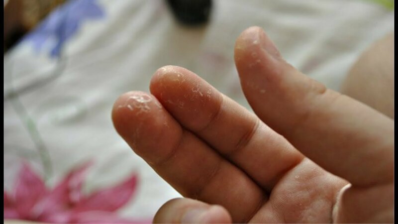 2 года у ребенка слезает кожа с пальцев рук thumbnail