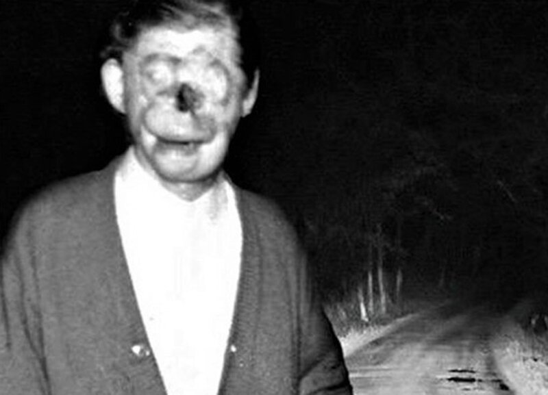 Известен как «Чарли без лица», Рэймонда Робинсона ударило напряжением в 11 000 вольт, когда ему было 8 лет, оставив дыры там, где когда-то были его глаза и нос. 