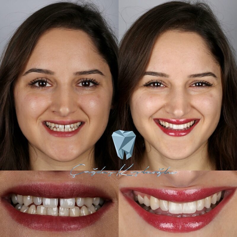 Красивые зубы фото до и после