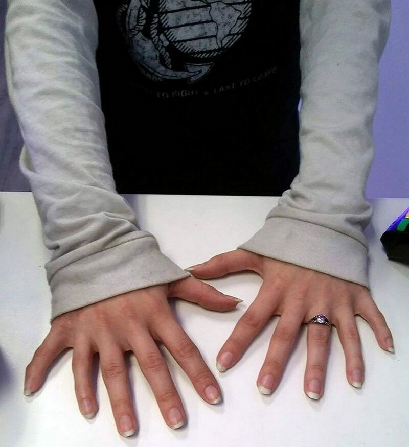 У клиентки на каждой руке по 6 пальцев.