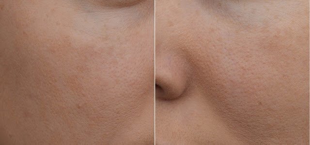 Шелушение кожи: причины, симптомы, лечение