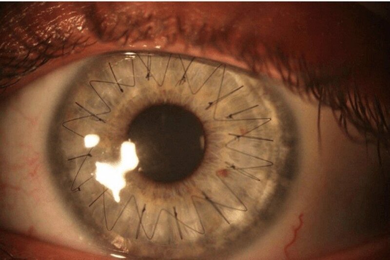 Глаз человека после пересадки роговицы