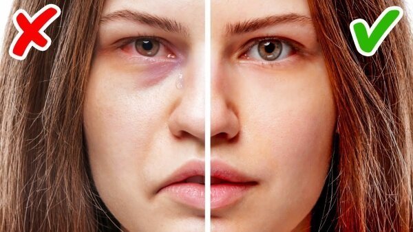 Почему отекает лицо и глаза по утрам: причины, симптомы заболеваний и  способы устранения