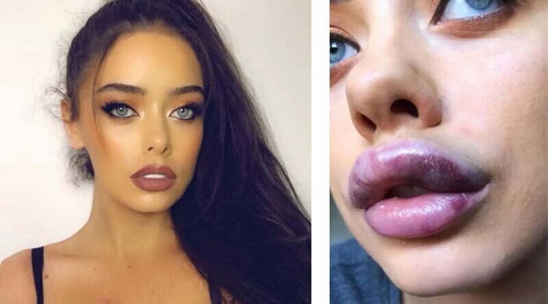 Пластический хирург объяснила, зачем девушки делают огромные губы
