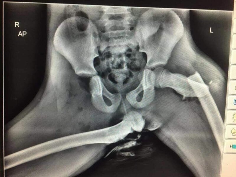 Последствия этой небольшой аварии показаны на рентгеновском снимке.