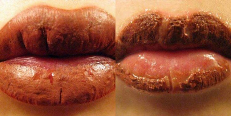 Причины осложнений после татуажа губ