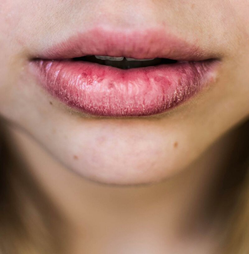 Заболевания, при которых болят губы, и ощущается жжение