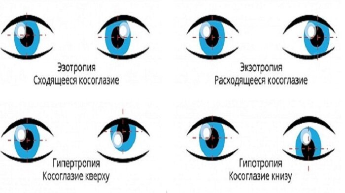 Мкб 10 расходящееся косоглазие. Эзотропия сходящееся косоглазие. Косоглазие степень зрения. Нарушение зрения косоглазие. Строение глаза при косоглазии.