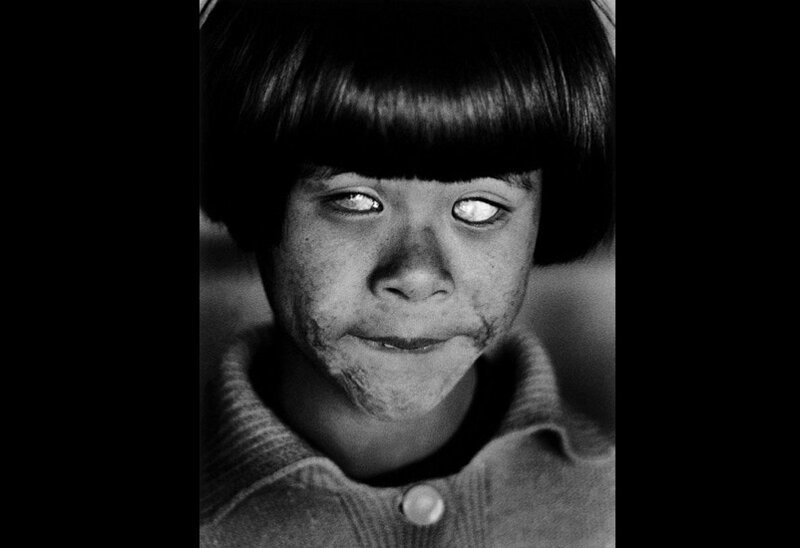 Маленькая слепая девочка после взрыва ядерной бомбы в Хиросиме.