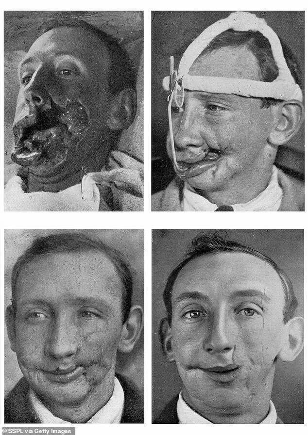 20 шокирующих фото о первых пластических операциях из прошлого
