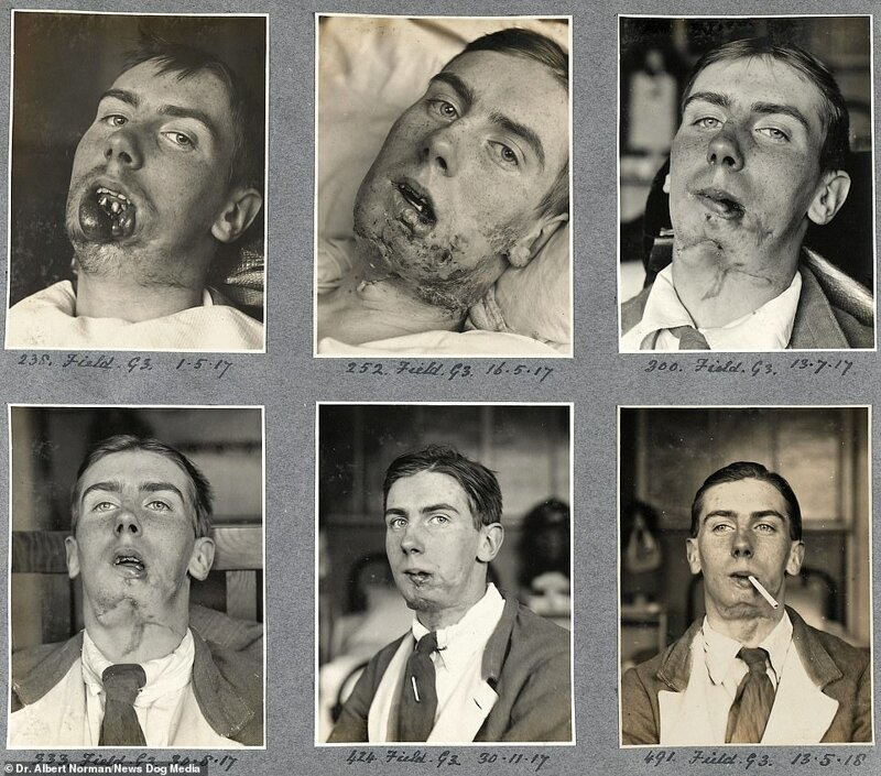20 шокирующих фото о первых пластических операциях из прошлого
