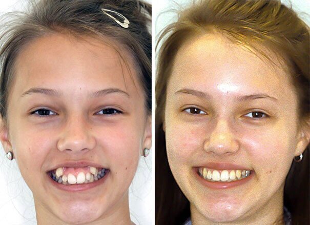 Как брекеты меняют лицо? Влияние ортодонтического лечения на внешность пациента