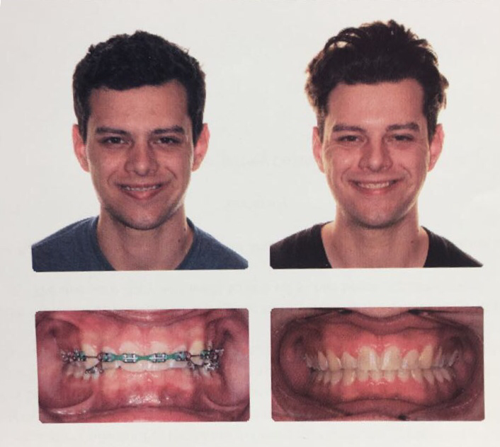 Как изменяется лицо после брекетов фото до и после
