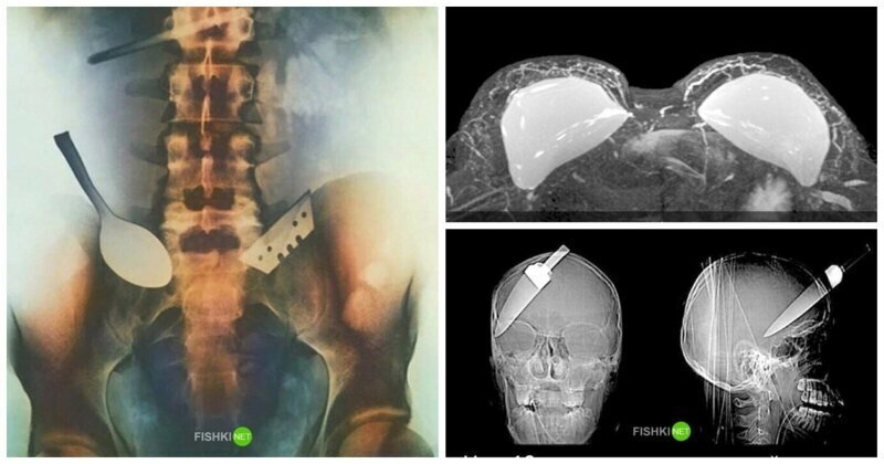 20 случаев из жизни рентгена, который видел некоторый ужас