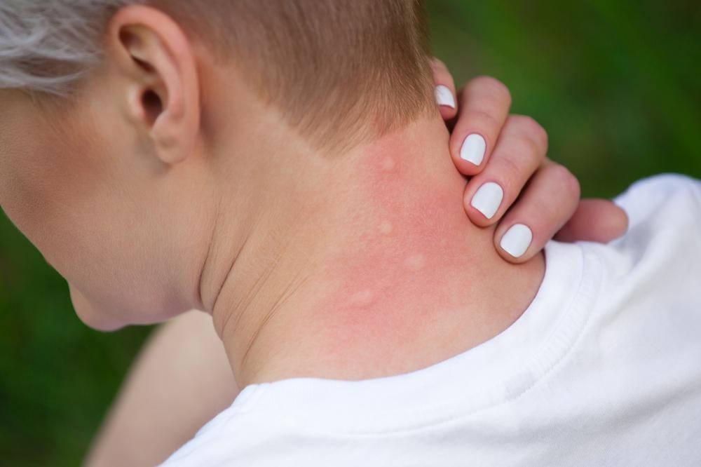 Почему возникает аллергия на комаров