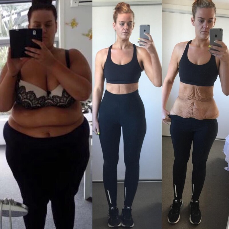 25-летняя новозеландка похудела на центнер и показала фото процесса преображения