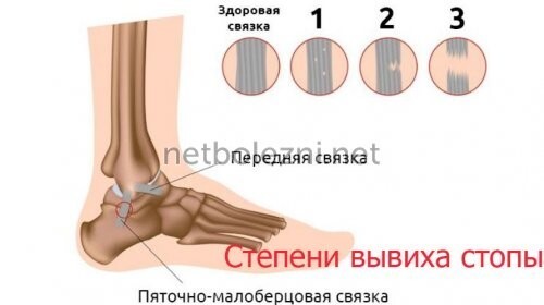 Подвернул ногу как лечить