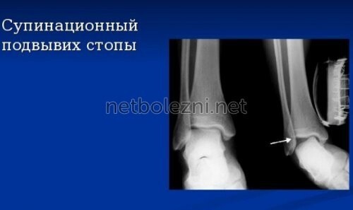 Подвернул ногу как лечить