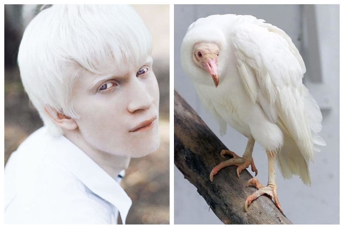 Альбинизмом страдают. Глазокожный альбинизм 2. Тотальный альбинизм.