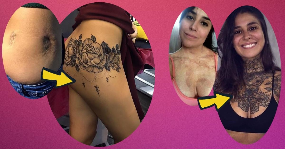 До и после: невероятные преображения людей с сильными рубцами после ожогов и шрамами