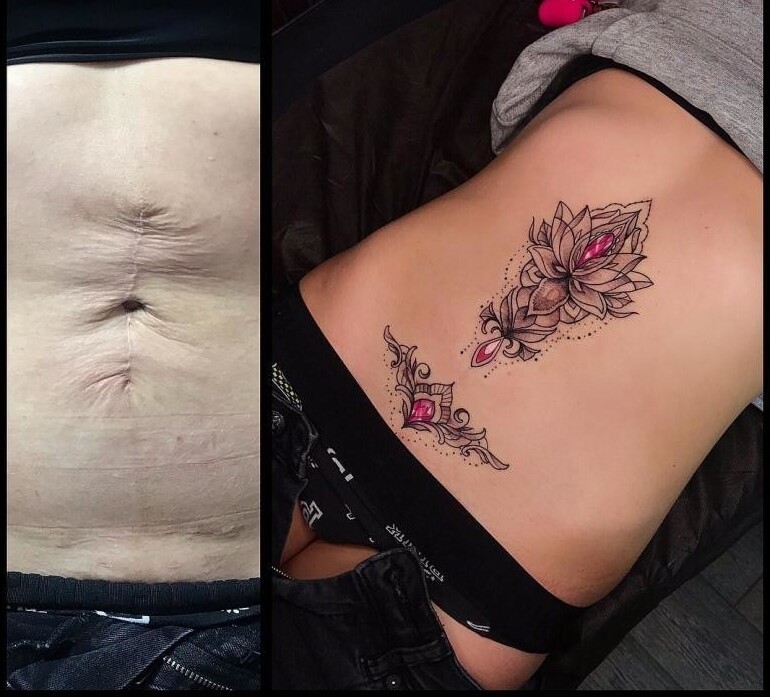 До и после: невероятные преображения людей с сильными рубцами после ожогов и шрамами