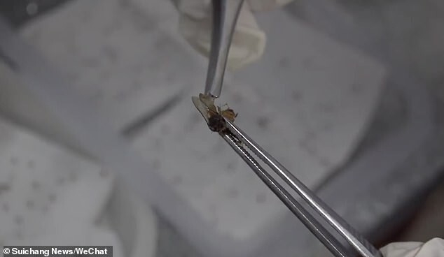 Из тела китаянки вытащили более 400 пчелиных жал