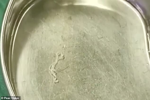 Из головы китайца удалили 12-сантиметрового червя