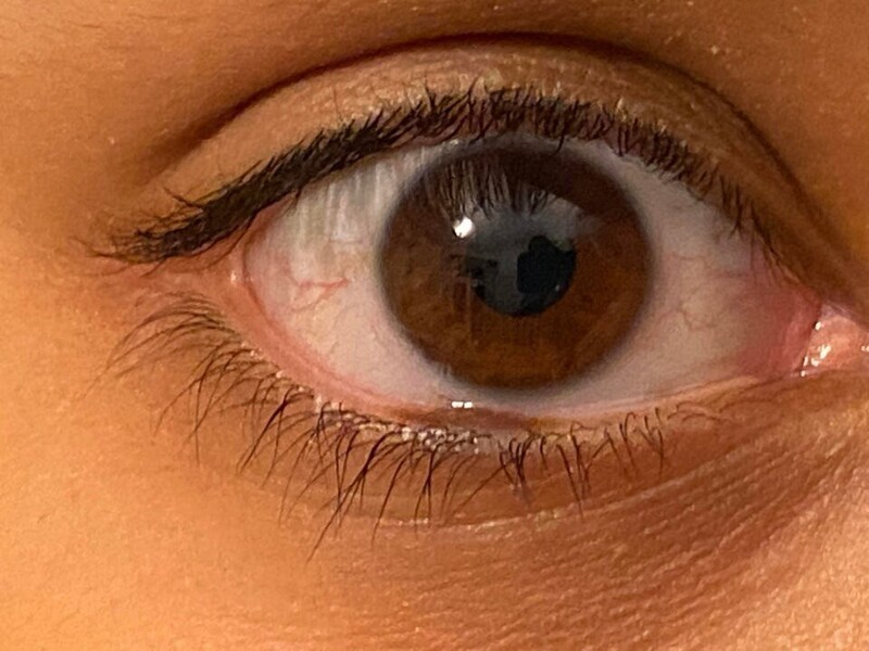 9. «У меня на слизистой глаза есть родимое пятно»