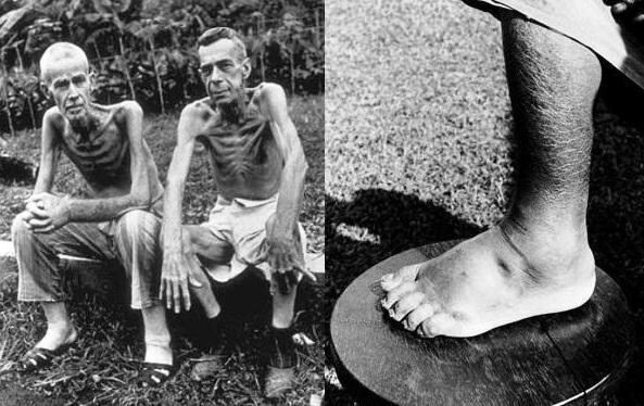 Голодная смерть: от цинги до пеллагры