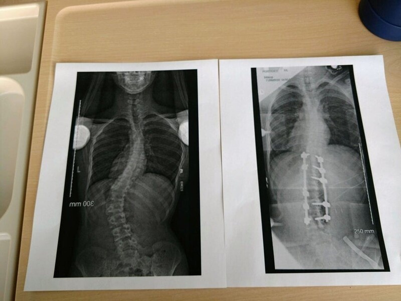 11. «Спина моего брата до и после операции по исправлению сколиоза»
