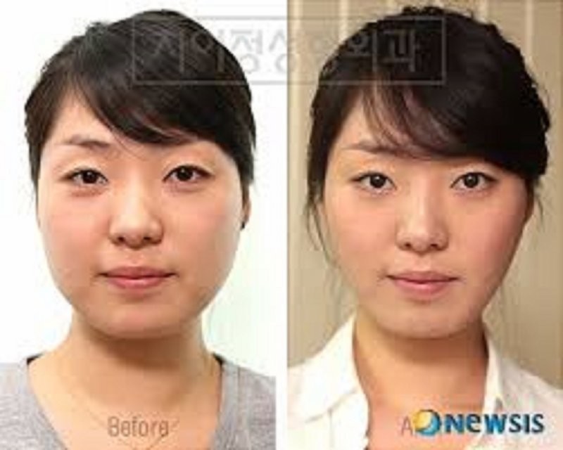 "Пластическая хирургия это как наркомания, - сказала корейская красавица, победительница конкурсов в одном из интервью. - Если вы исправили глаза, то вам тут же захочется исправить и нос".