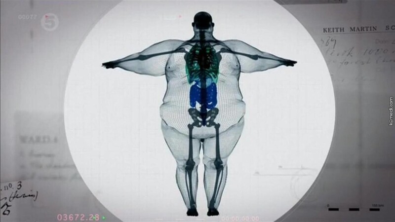 9. Скелет самого толстого человека в мире