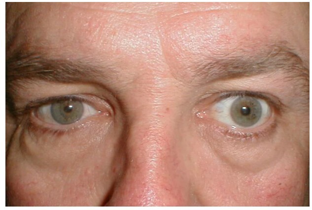 "Красивые глаза" как симптом болезни