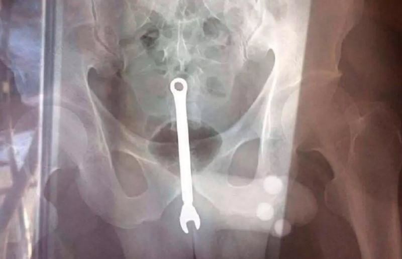 За прошедшие праздники москвич дважды обращался к врачам с деликатной проблемой