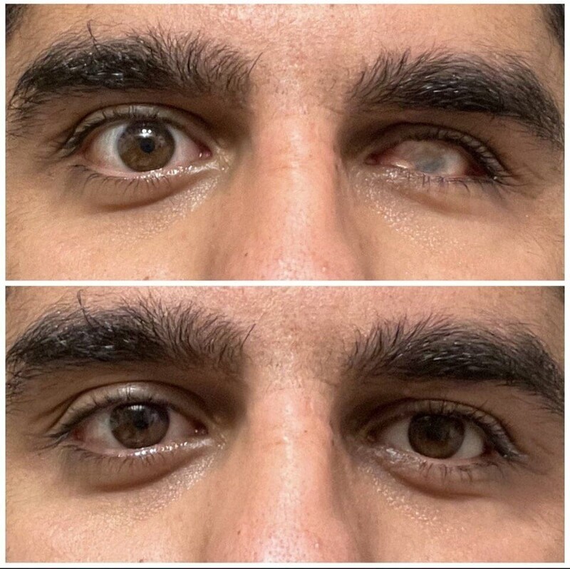 До и после того, как я надеваю искусственный глаз