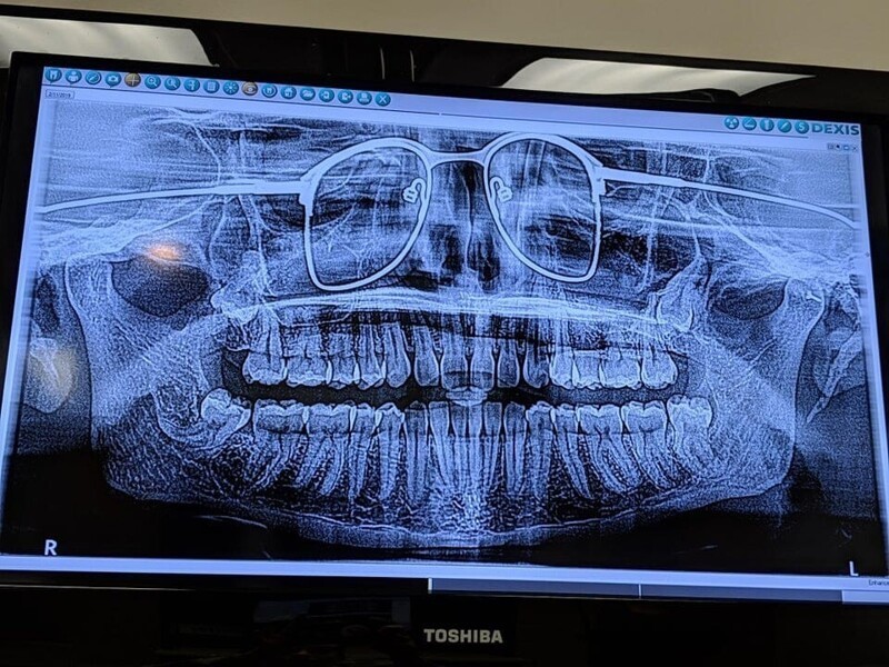 Стоматолог забыл попросить меня снять очки на рентгене
