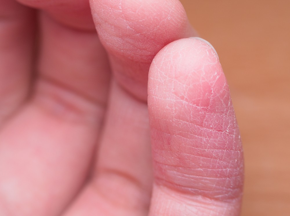 Почему шелушится кожа на руках, ногах и других частях тела
