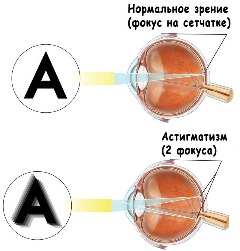 Тест на астигматизм: врач-окулист поделилась простым способом, помогающим определить дефект зрения
