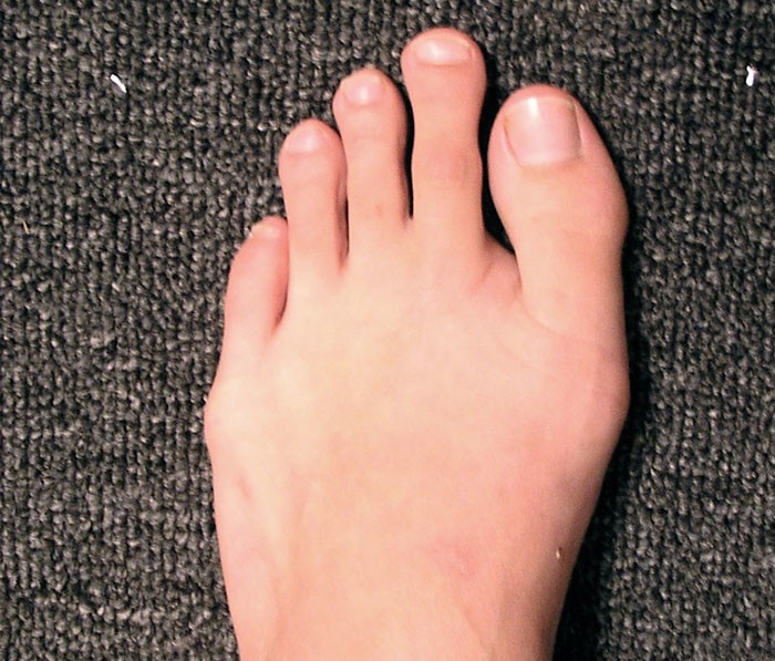 8. Примерно у 10% людей есть палец Мортона - особенность строения стопы, при которой второй палец длиннее большого.