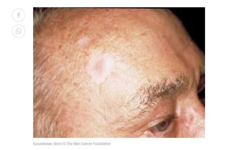 7. Побледневший участок кожи на голове или шее