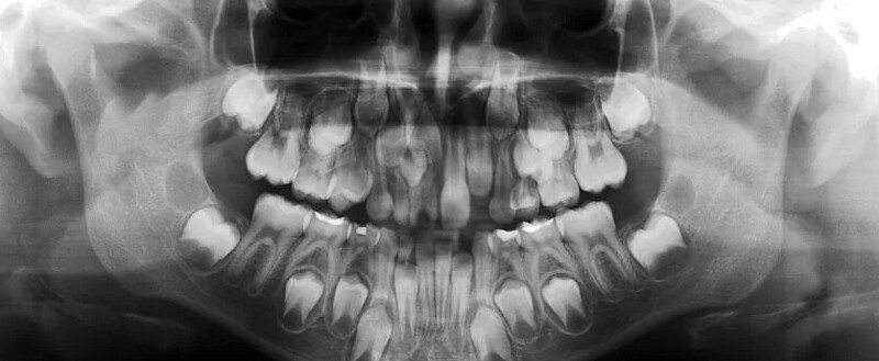 Пугающие факты о человеческом теле: как возникает аномалия зубов